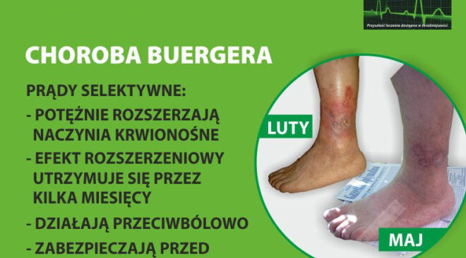 Leczenie choroby Buergera Bielsko-Biała